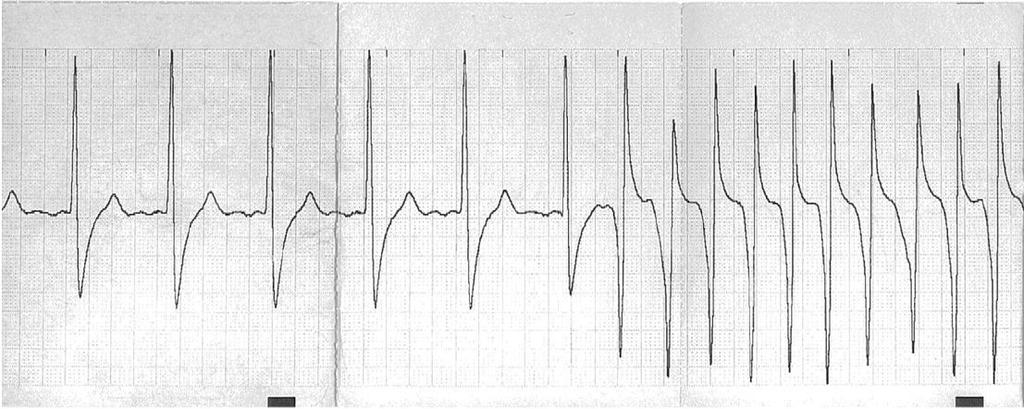 ICD-Therapie 15 Minuten und 2 Stunden vorausgingen Monomorphe, plötzlich einsetzende VT, nicht durch