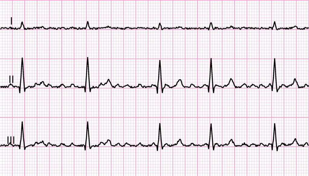 Weiterführende Informationen zu Fall 2: Zur Abklärung des Befundes wurde folgendes EKG vom Patienten geschrieben: Können Sie Hinweise auf Veränderungen im rechten Ventrikel in der EKG-Ableitung