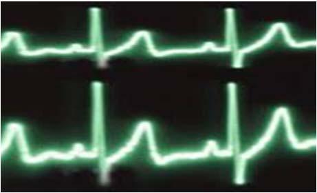 Martin Donath Folie 5 Modell Analyse und Berechnungsweg Arzt: Herz - EKG als