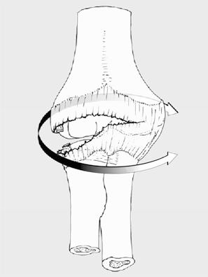 [22] mit Reißen der ligamentären Strukturen mit zunehmenden Schweregrad in einem kreisförmigen Verlauf vom lateralen ulnaren Kollateralband (LUCL) zum medialen ulnaren Seitenband (MUCL).