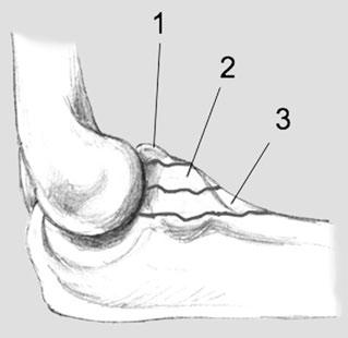 (Aus [23]) Ulnarer Bandkomplex. Das MUCL ( medial ulnar collateral ligament ) dient zur medialen Stabilisierung gegen Valgusstress.