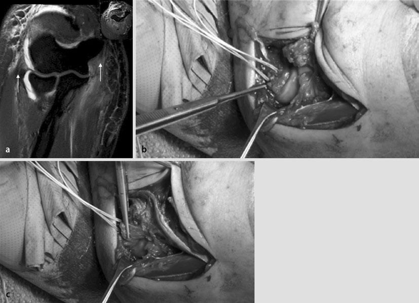 Abb. 19 9 MUCL- und LUCL-Läsion (a), LUCL-Refixation (b,c), LUCL lateral ulnar colateral ligament, MUCL medial ulnar collateral ligament Abb.