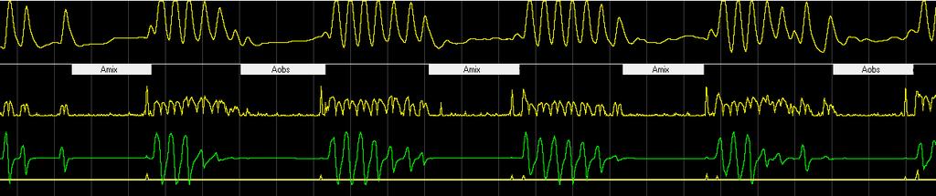 4. DISKUSSION Übereinstimmung der AHI. Dabei sind die Hypopnoen mit dem gleichen Signal gemessen worden, sodass keine Aussage über den PneaVox-Sensor allein getroffen werden kann.