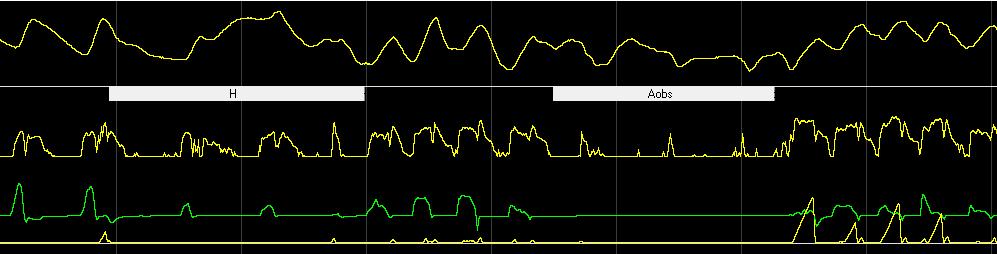 4. DISKUSSION Das Atemfluss-Signal des PneaVox-Sensors besteht aus einer M-förmigen Kurve, welche die Inund Exspiration darstellt.