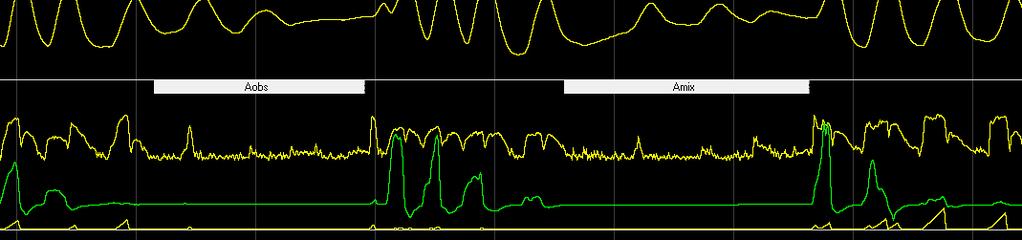 Signale von oben: Thermistor, Sound, nasaler Atemfluss, Ton 2 Hypopnoen und Apnoen markiert ( H und Aobs ) 10 Sek. Abbildung 33: Ausschnitt aus Auswertung A im 2-Minuten Fenster.