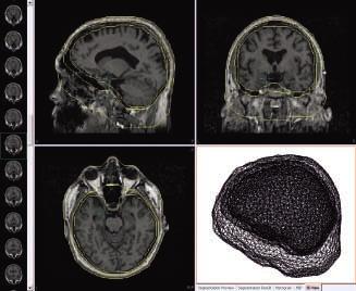 Abbildung 1 Aus kernspintomographischen Aufnahmen berechnete Grenzflächen der relevanten leitenden Bereiche des Kopfes (Haut, Knochen, Gehirn; links und oben), aus denen ein realistisch geformtes,
