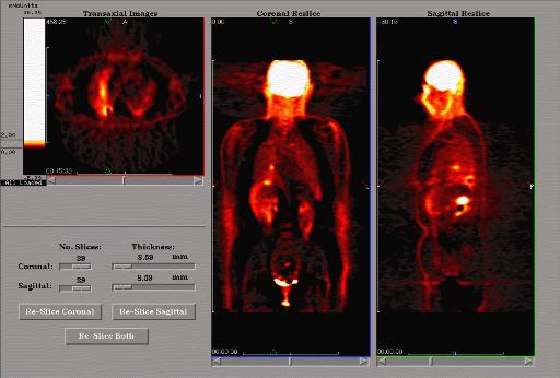 PET-SCAN