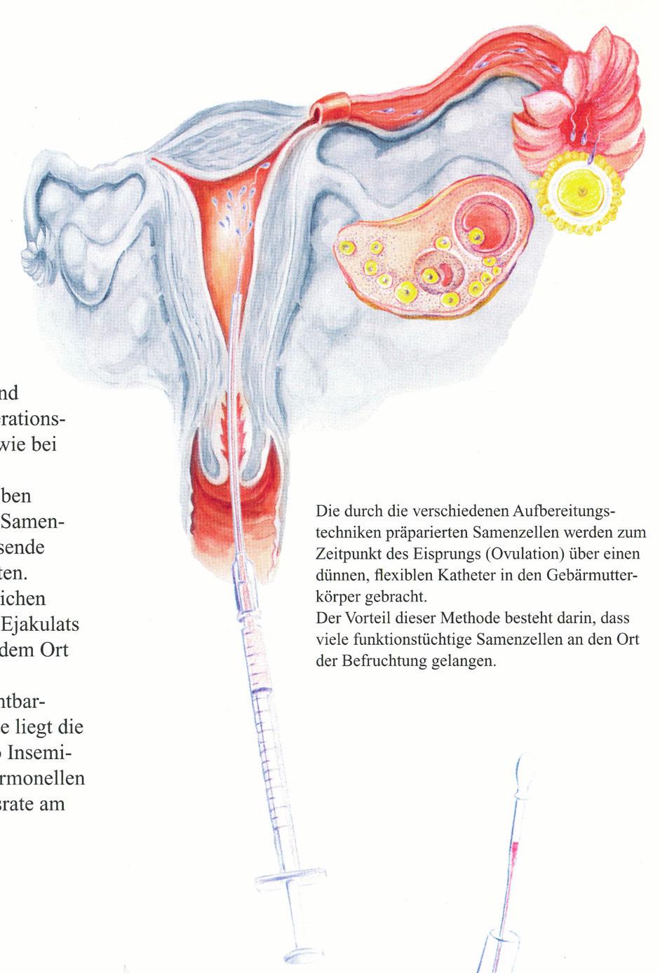 Die lnsemination Unter lnsemination versteht man eine künstliche Samenübertragung in den Gebärmutterkörper (intrauterin) mit Hilfe eines feinen Katheters zum Zeitpunkt des Eisprungs (Ovulation).