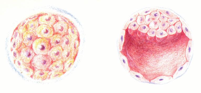 Therapie nach dem Embryotransfer Maulbeerkeim Embryotransfer Blasenkeim Die Übertragung von maximal drei Embryonen erfolgt mit einem feinen, biegsamen Katheter.