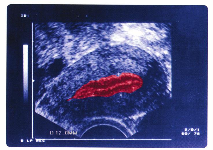 Nach Spülung des Gebärmutterhalses werden die Embryonen in den Katheter aufgezogen und über den Gebärmutterhals in den Gebärmutterkörper transferiert.