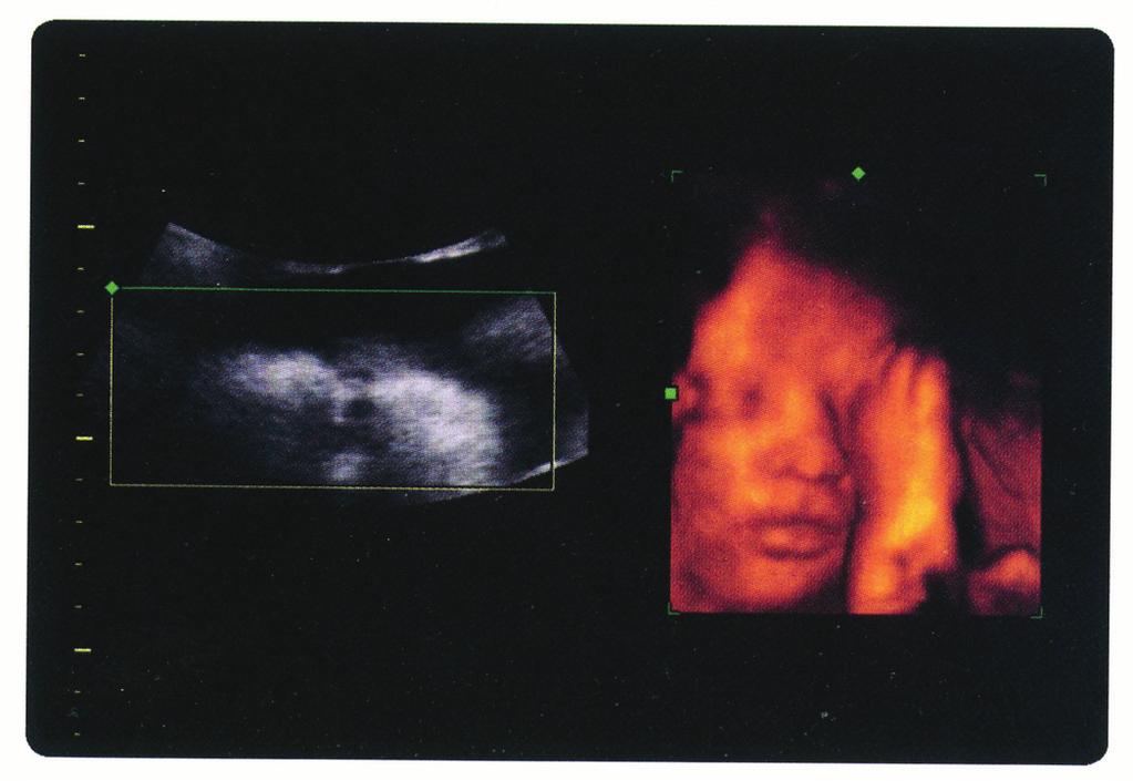 Schwangerschaft Ebenso wie bei den natürlich eingetretenen Schwangerschaften können auch bei den durch In-vitro-Fertilisation erreichten Schwangerschaften Komplikationen auftreten wie z.b. eine Fehlgeburt oder drohende Frühgeburt.