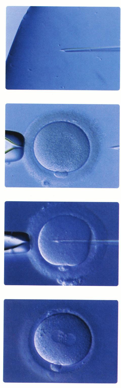 Einfangen und Aufsaugen einer einzelnen Samenzelle mit der feinen Injektionskapillare Fixieren der Eizelle