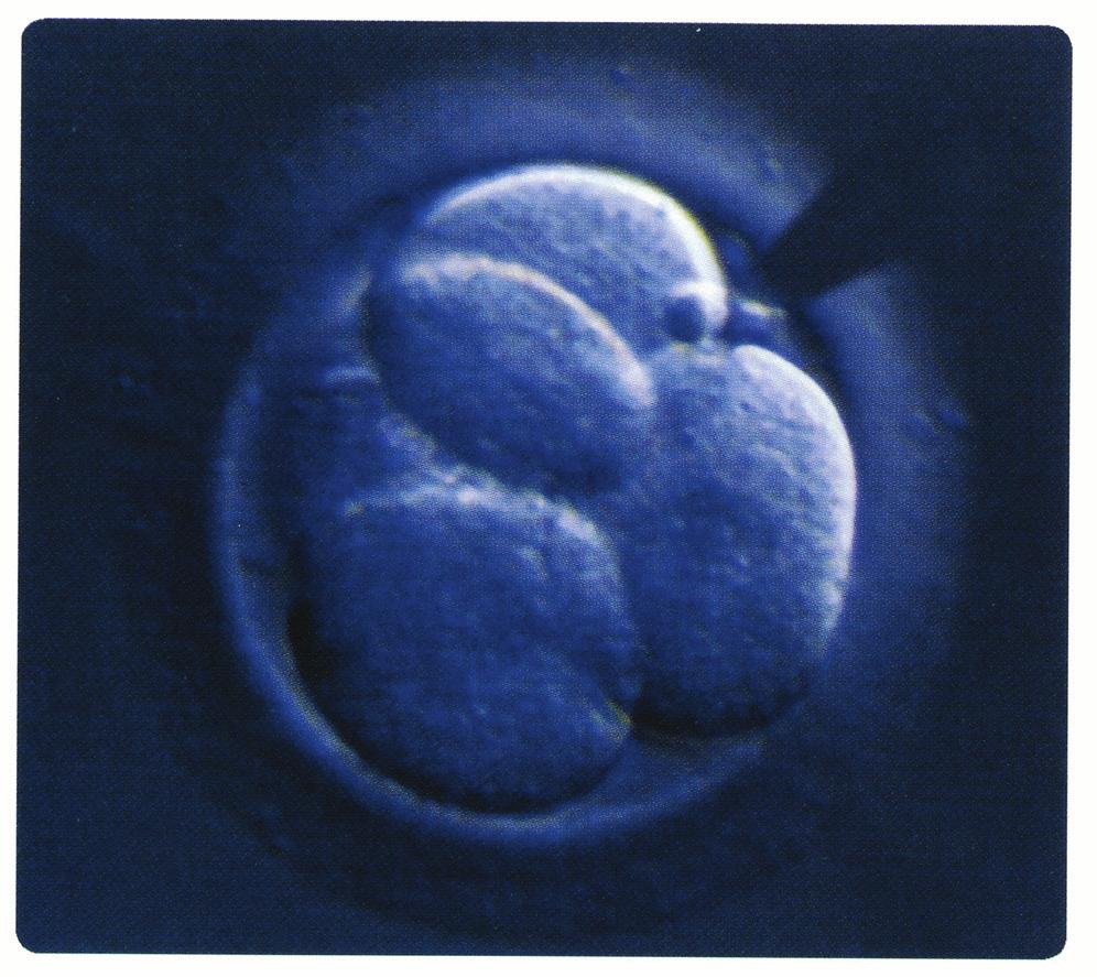 22 Kryo-TESE-ICSI Finden sich keine Spermatozoen in der Samenflüssigkeit (Azoospermie), so können aus einmalig operativ gewonnenen, kryokonservierten Hodengewebsproben einzelne Spermatozoen isoliert