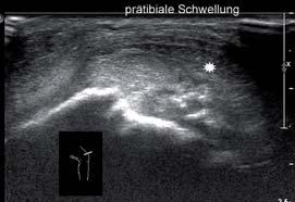 3.4: Tuberositas tibiae: Sonographie transversal Für primäre Weichteilverletzungen bietet