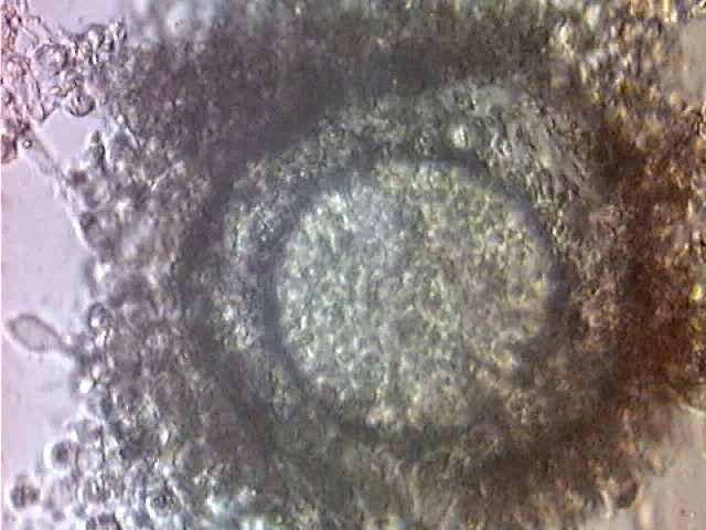 Indikationen IVF In Vitro Fertilisation Tubare
