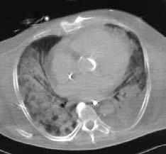 4 Thorax-CT bei ARDS.