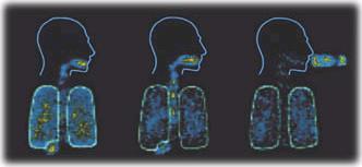 Lungendeposition je nach Inhalator und Management (sintigraphische Darstellung) Respimat MDI MDI + Spacer 39 % 20 % 25 % nach: Newman SP.