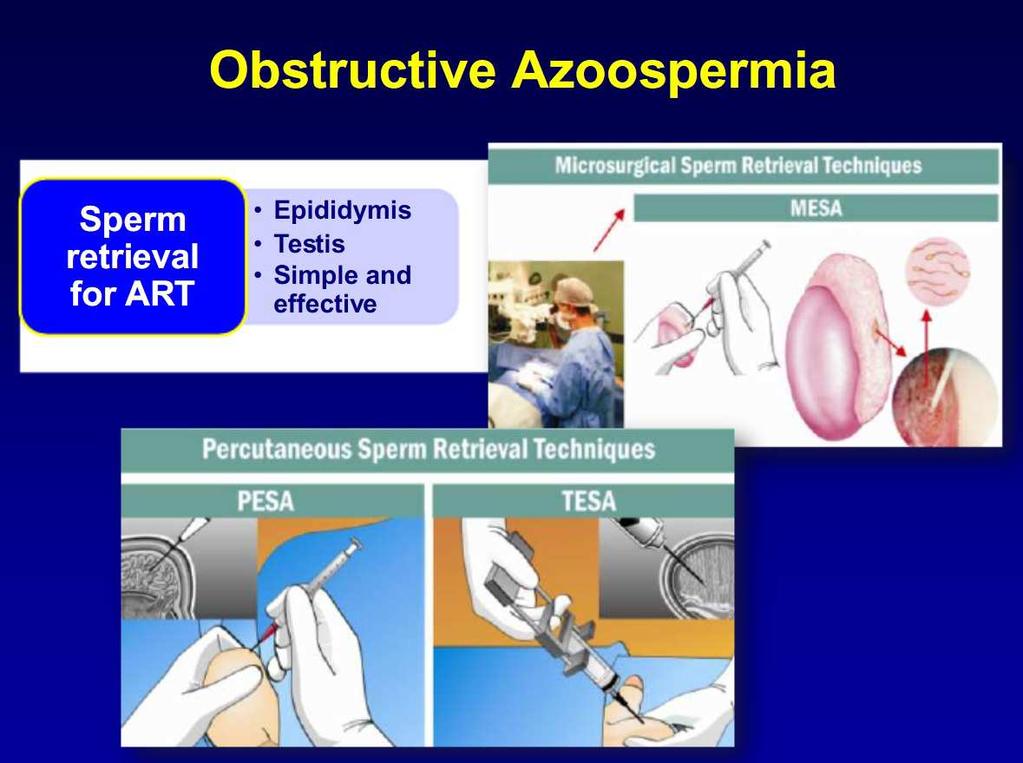 Abbildung 3 zeigt schematische Darstellung der operativen Behandlungsmöglichkeiten der obstruktiven Azoospermie. Abb.