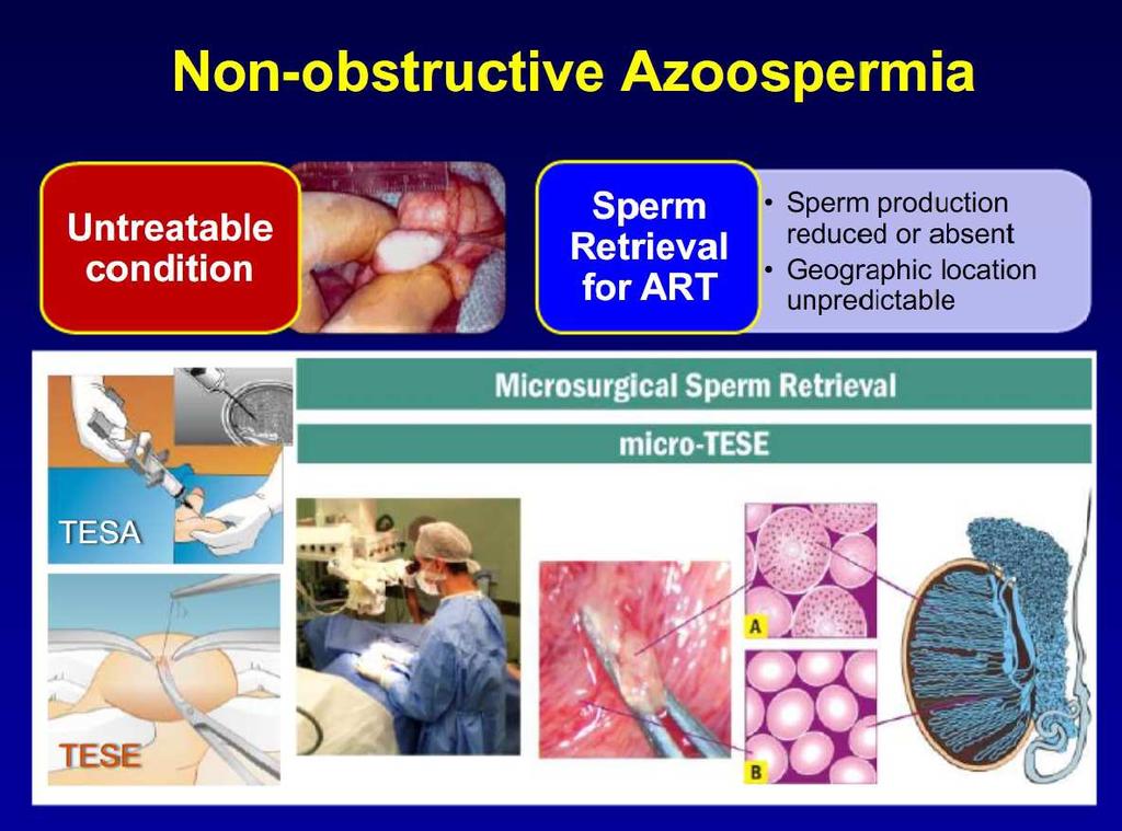 Abbildung 4 zeigt schematische Darstellung der operativen Behandlungsmöglichkeiten der nicht obstruktiven Azoospermie. Abb.