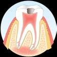 Der Zahn wird druckempfindlich und lockert sich. Im schlimmsten Fall muss der Zahn gezogen werden.