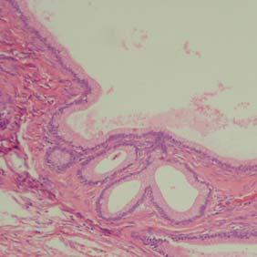 Ovarialstroma, Corpoara albicantia (Tube) MUCINÖSES ZYSTADENOM DES OVARS Cystenwand mit einreihigem