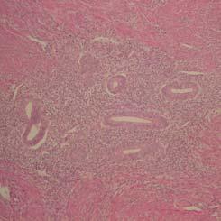Cervixkarzinom 21 PAP II 22 PAP IV GLANDULÄR-CYSTISCHE HYPERPLASIE DES ENDOMETRIUMS Glatte Muskulatur mit Endometrium Endometrium verbreitert Drüsen mit erweitertem Lumen (