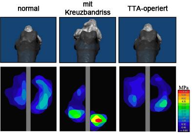 Vergleich der Ergebnisse beider Methoden in der Literatur Nach der TTA waren keinerlei signifikanten Unterschiede im Kontaktmechanismus und den kinematischen Parametern zum normalen Kniegelenk mehr