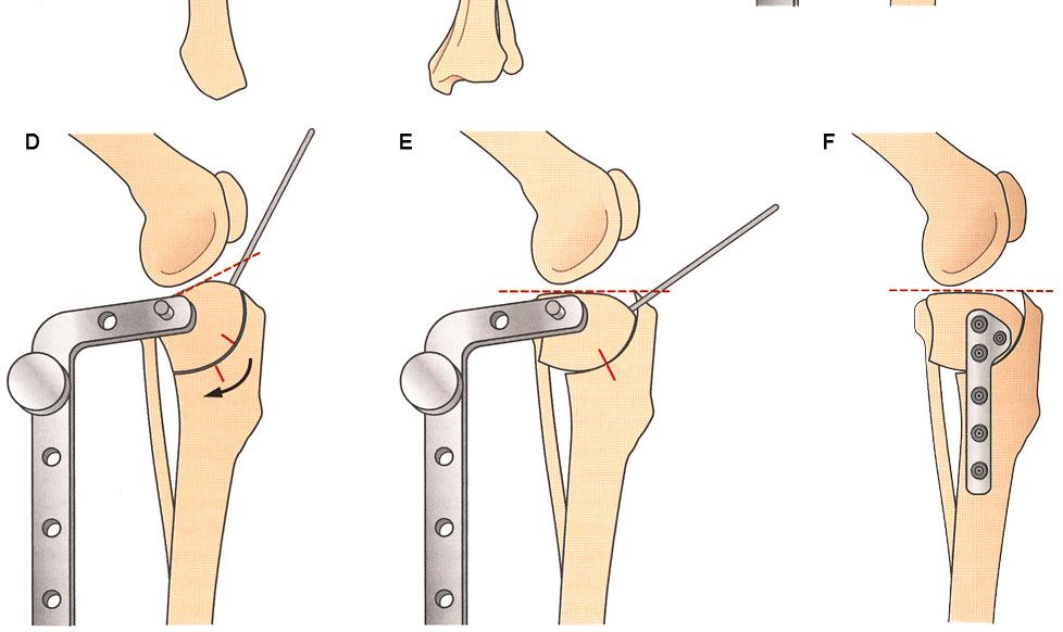 C: Die Osteotomie erfolgt bis zu einer Tiefe von einem Drittel des Knochens, wobei die Säge parallel zu den Jig-Pins gehalten wird.