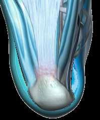 Der Fuß weist folgendes Erscheinungsbild auf: Ansicht: medial Insuffiziente Bänder und Muskeln führen zur Abflachung des