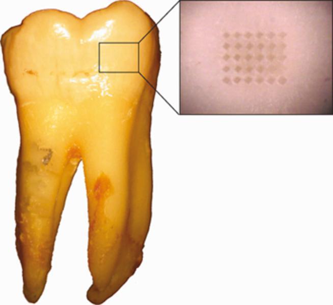 Probenentnahm e für die Analyse von Strontium isotopen: unterer m enschlicher Backenzahn (links) und Nahaufnahm e der Oberfläche des Zahnschm elzes m it m ikroskopisch kleinen Löchern (rechts).