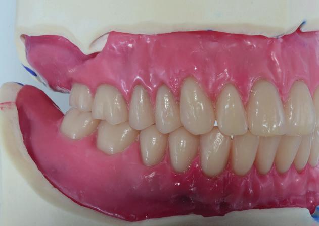 10 Kreuzbiss-Aufstellung mit Typ-Seitenzähnen In Funktion Vergleich Normalbiss- und Kreuzbiss-Aufstellung Zentrik Normalbiss Die Zähne sind in einer Zahn-zu-zwei-Zahn- Beziehung auf gestellt.