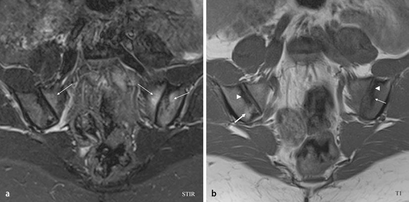 Abb. 2 9 MRT der Sakroiliakalgelenke: STIR- (a) und T1-Sequenzen (b) einer 22-jährigen Patientin mit entzündlichem Rückenschmerz seit 3 Jahren ohne definitive Sakroiliitis im Röntgenbild.