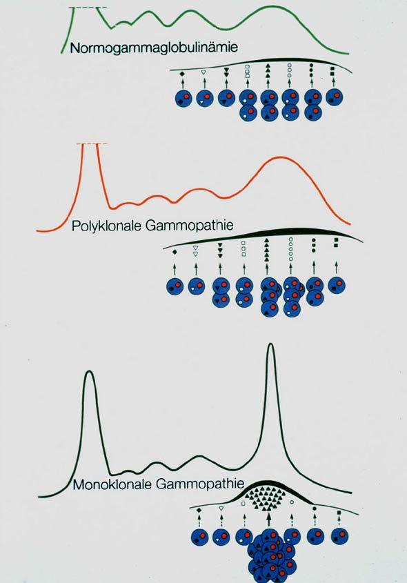- 3 - Formen der Gammopathie Polyklonale Gammopathie Monoklonale Gammopathie Infektionen, Entzündungen, Autoimmuno- und