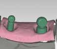 Kiefergelenk-Daten in CAD und IMPLA 3D Navi Tizian Fräsanlagen Fräsen der CAD-Daten IMPLA Scan- Abutments