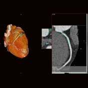 Es zeigt sich in der CT-Angio der Herzkranzgefäße