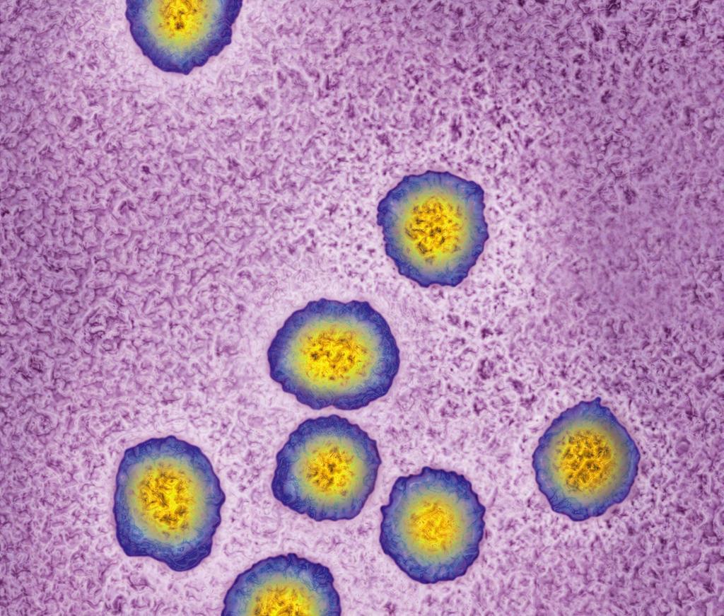 Chronische Infektionen mit dem Hepatitis C-Virus können zu Leberzirrhose und Leberkrebs führen.