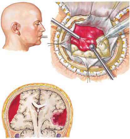 Subduralhämatome Anatomie auf S.