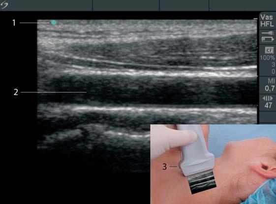 12 Kapitel 2 Abbildungskonventionen und Schallkopfführung 2 Orientierung auf einem Ultraschallbild Um den Schallkopf entsprechend dem auf dem Monitor dargestellten Bild zu definieren, ist an allen