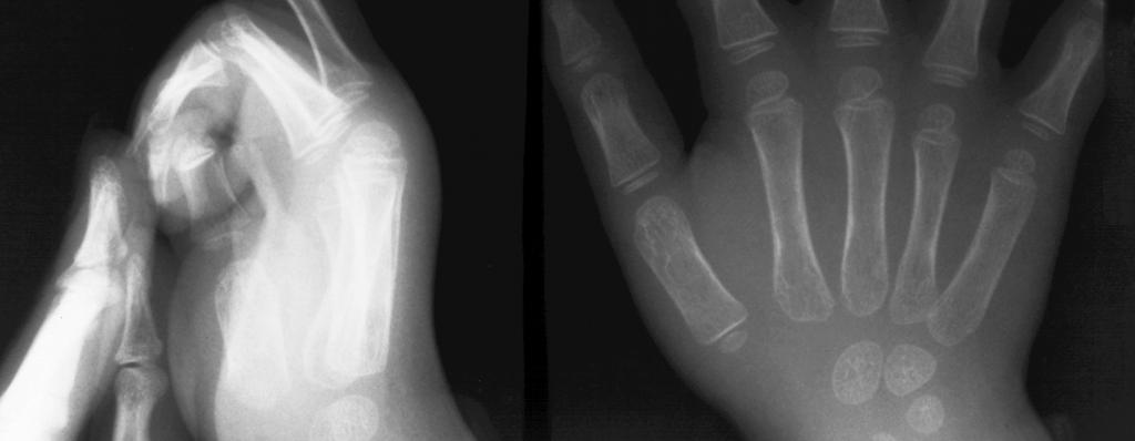 Röntgenbild einer AKZ in der Mittelphalanx D3 In zwei Fällen machte erst eine pathologische Fraktur auf die Läsion aufmerksam, in zwei anderen Fällen war eine eingeschränkte Beweglichkeit im