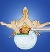 SpineTIP Perkutane und endoskopische Zugänge Transforaminaler Zugang Spül-/ Saugkanäle 25 25,5 cm Optische Linse