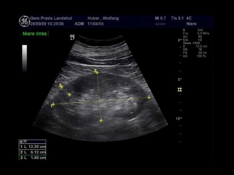 Ultraschall der Nieren Große Niere, z.b.