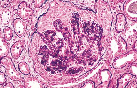 Glomerulosklerose. (F/Vandebildt Collection.) bbildung 62e-5 Fokal segmentale Glomerulosklerose mit Spitzenläsion (tip lesion).