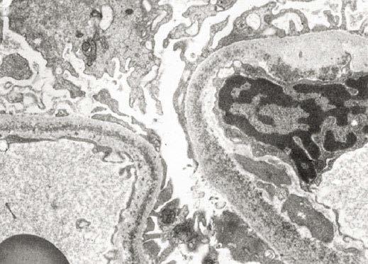 Lichtmikroskopisch liegt eine knotige Verbreiterung des Mesangiums vor ().