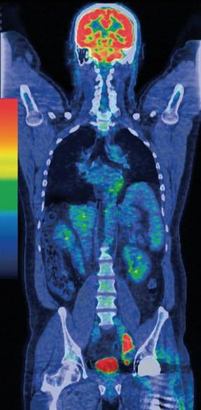 Christian-Albrechts-Universität zu Kiel - Medizinische Fakultät PET-CT Staging in Early Breast Cancer Systemic review of 28 studies Improved diagnosis accuracy No evidence of