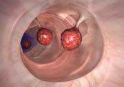 Das Endoskop wird durch den After in den Darm eingeführt und bis zum Übergang in den Dünndarm vorgeschoben (Abb. a).