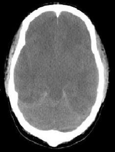 Schweres Dialyse Dysequilibrium Syndrom bei septischem Schock Bagshaw SM, BMC Nephrology 2004 22 jähriger Mann S. aureus Sepsis ph 6.