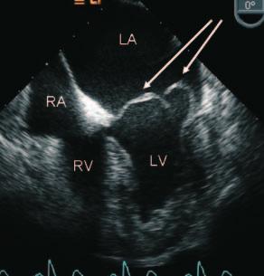 Abbildung 3 Echokardiographisches Bild eines schweren Mitralklappenprolapssyndroms mit einer schweren Mitralinsuffizienz.