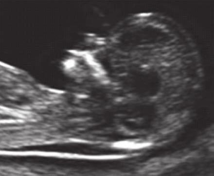 Grundlagen des ETT Ultraschall und Biochemie Der Ersttrimestertest besteht aus der Kombination einer Ultraschalluntersuchung mit einer Blutentnahme, welche beide im ersten Drittel der Schwangerschaft