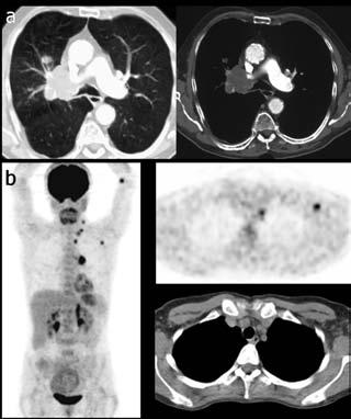 PET/CT in der Onkologie beim initialen Staging PET vs.
