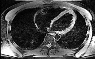 6 Aufnahme verschiedener Blickwinkel des Herzens Nach der Optimierung der Sequenzparameter wurden die Einstellungen für eine Darstellung des Herzens entlang seiner anatomischen Achsen untersucht.
